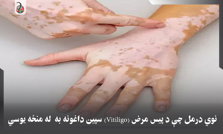 نوي درمل چې د پيس مرض (Vitiligo) سپين داغونه به  له منځه يوسي 