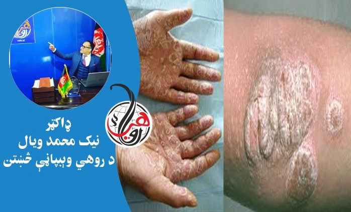 پسوريازيس (Psoriasis) د پوستکي ناروغي ده؛ لاملونه، نښې او درملنه يې دلته ولولئ 