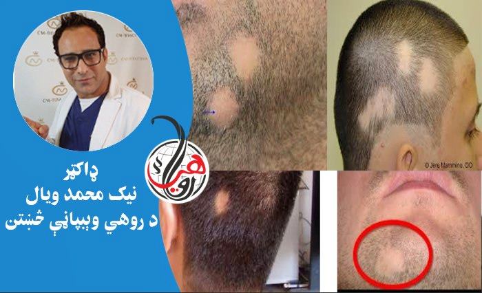 د وېښتانو توېدو ناروغي يا (alopecia): لاملونه او کورنۍ درملنه