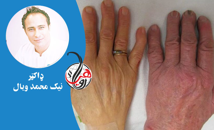 د وينې کمېدنه (کم خوني Anemia) څه ته وايي؟ نښې او لاملونه يې